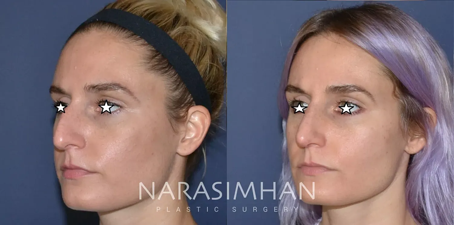 Facial Sculpting Before & After