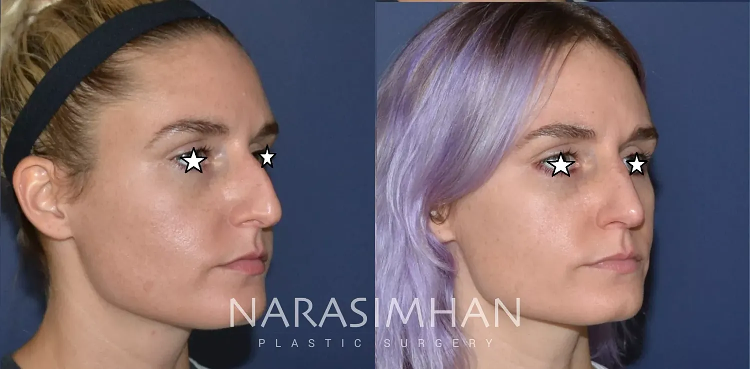 Facial Sculpting Before & After
