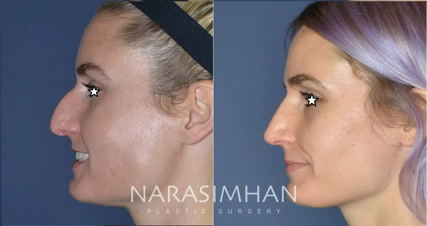 Facial Sculpting Before & After