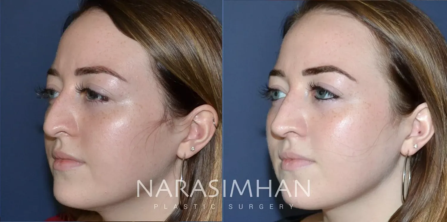 Facial Sculpting Before & After