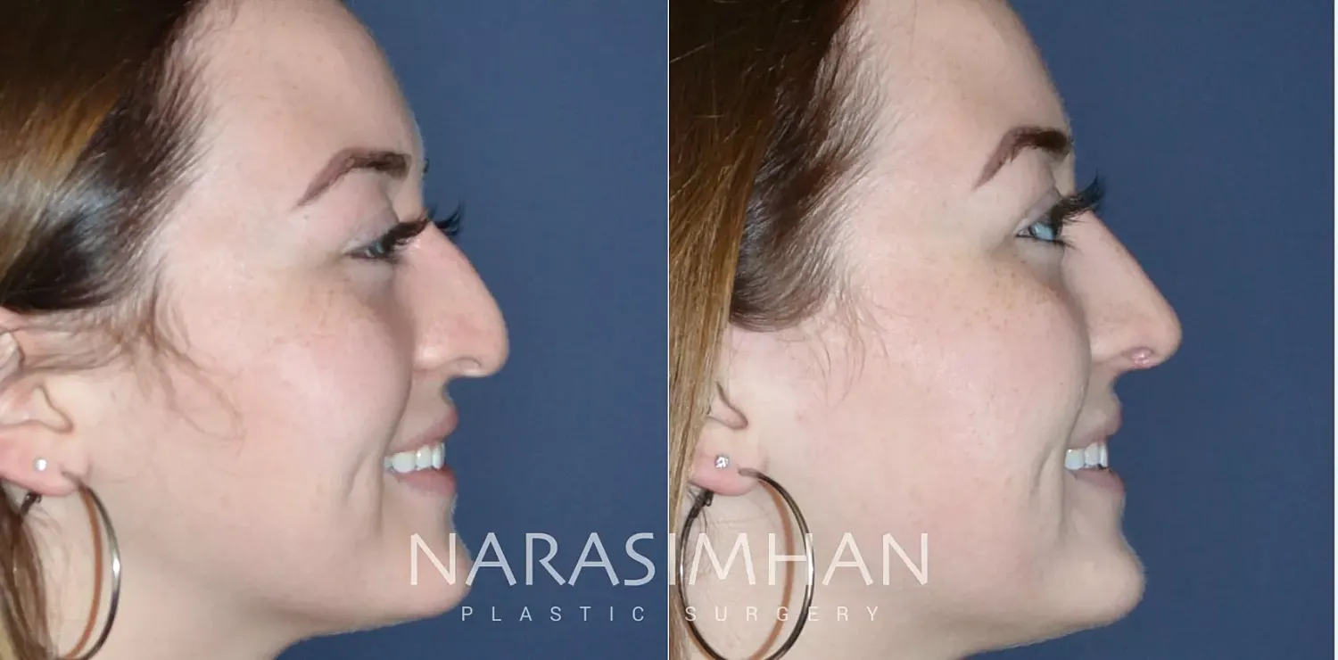 Facial Sculpting Before & After