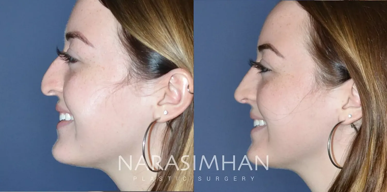 Facial Sculpting Before & After