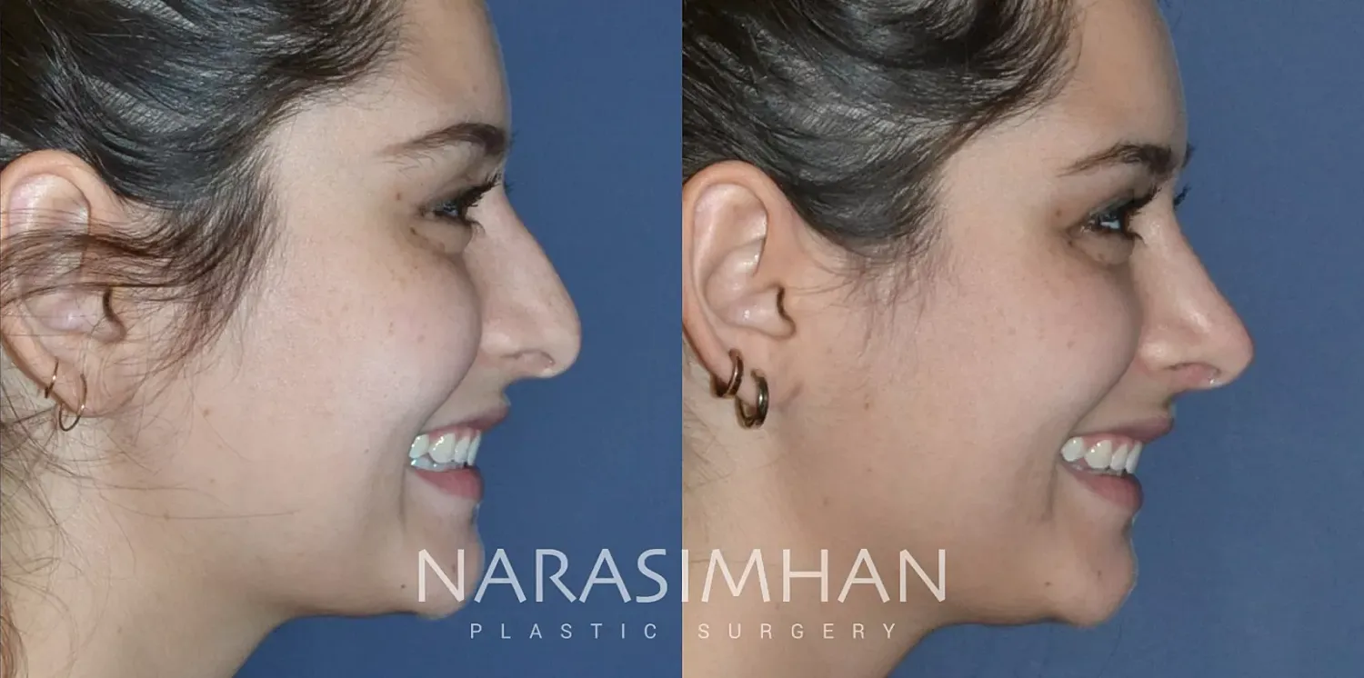 Facial Sculpting Before & After