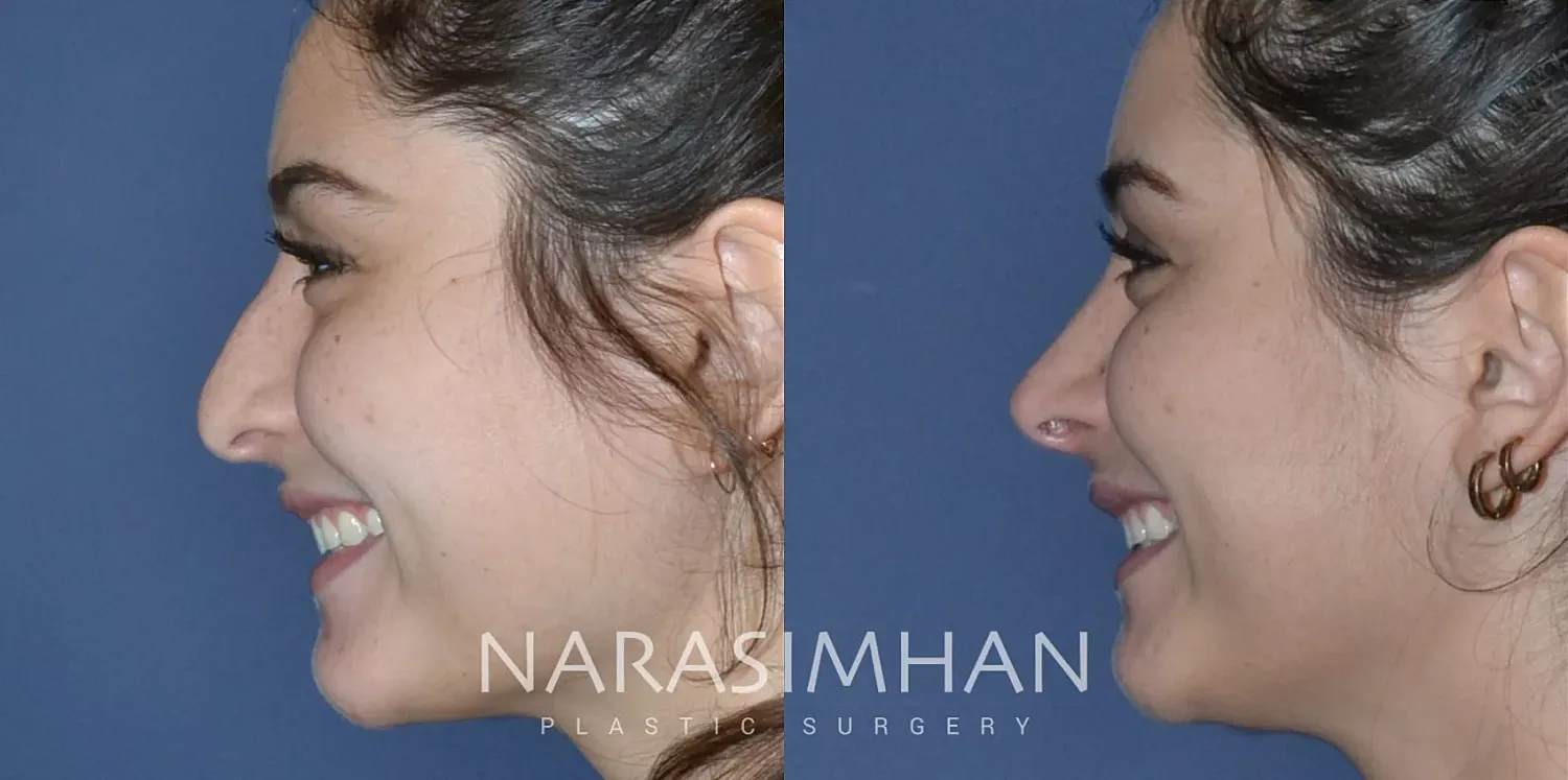Facial Sculpting Before & After