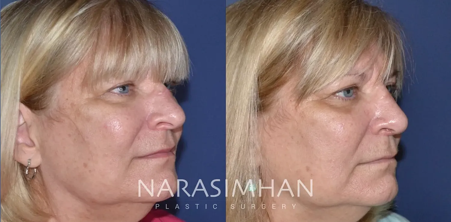 Facial Sculpting Before & After