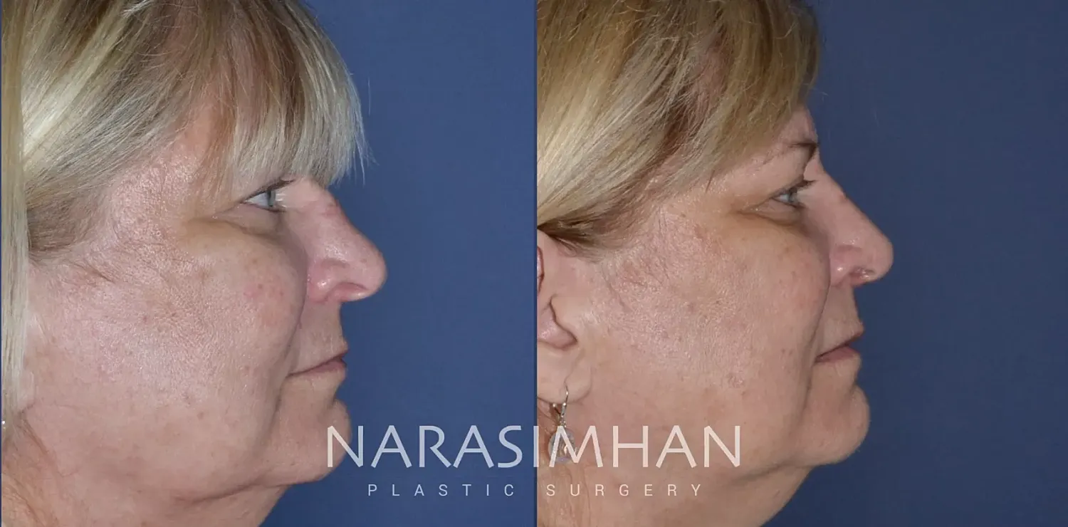 Facial Sculpting Before & After