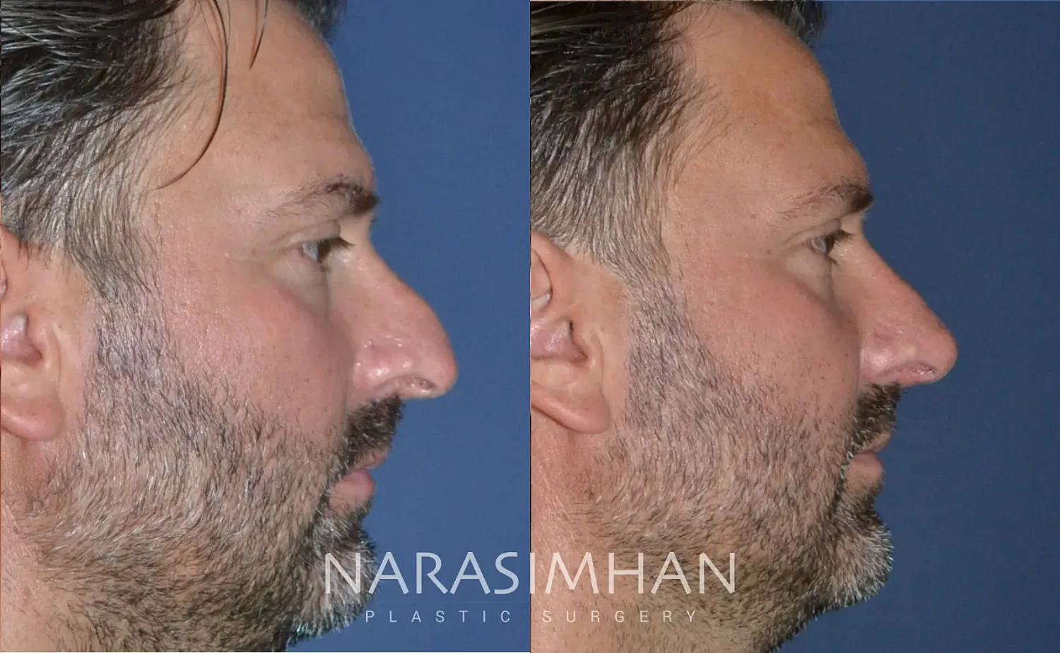 Facial Sculpting Before & After
