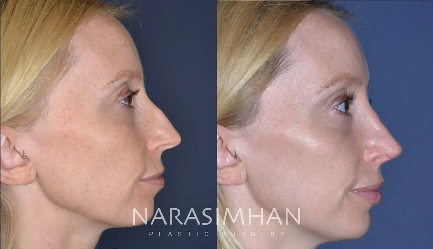 Facial Sculpting Before & After