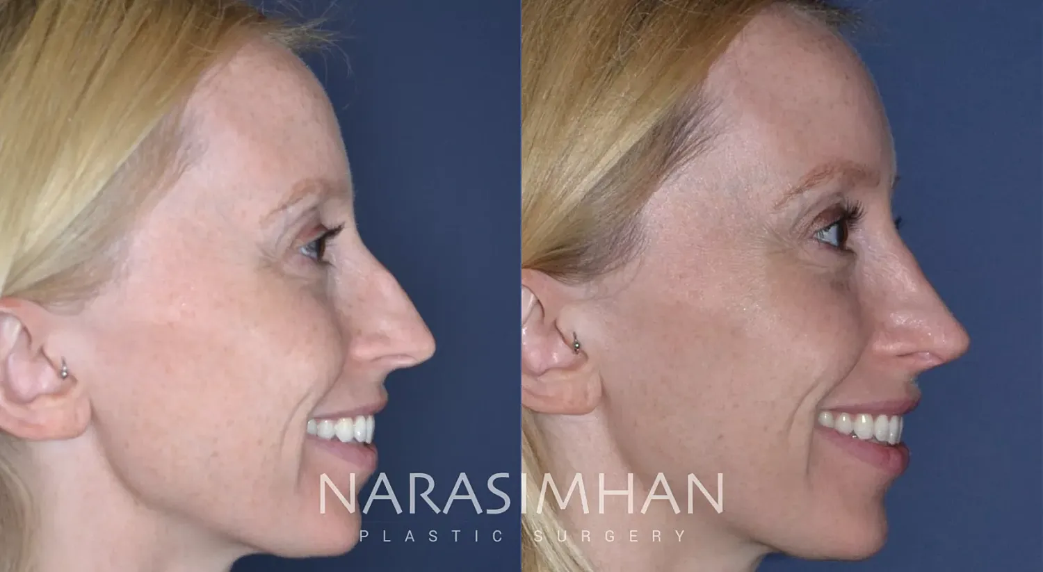 Facial Sculpting Before & After