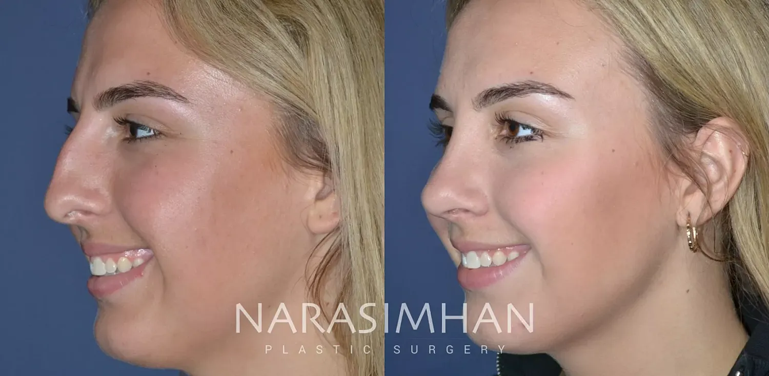 Facial Sculpting Before & After