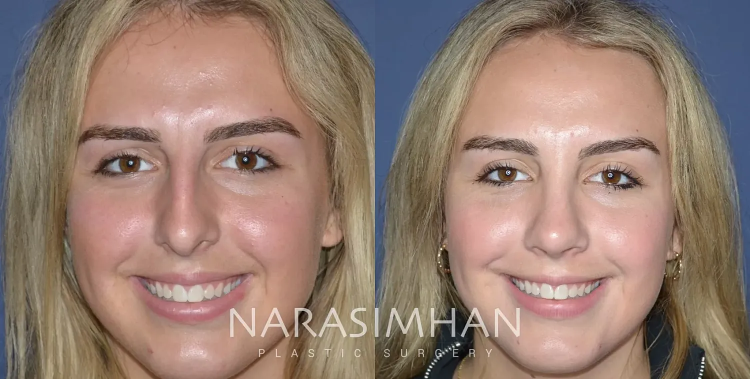 Facial Sculpting Before & After
