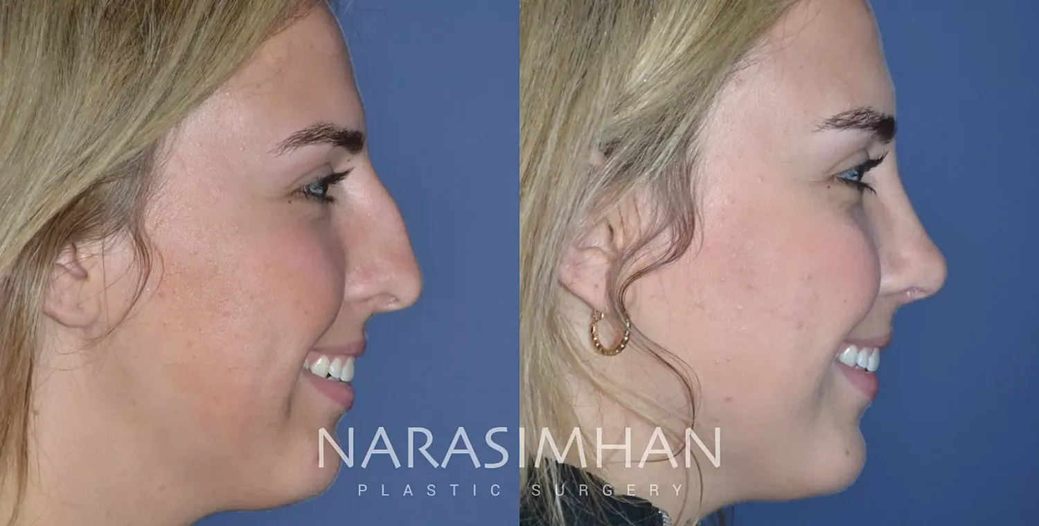 Facial Sculpting Before & After
