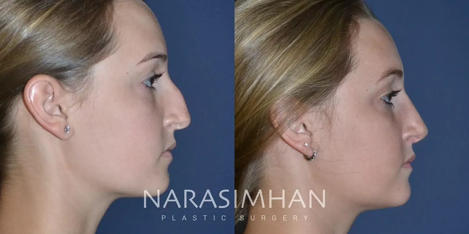 Facial Sculpting Before & After