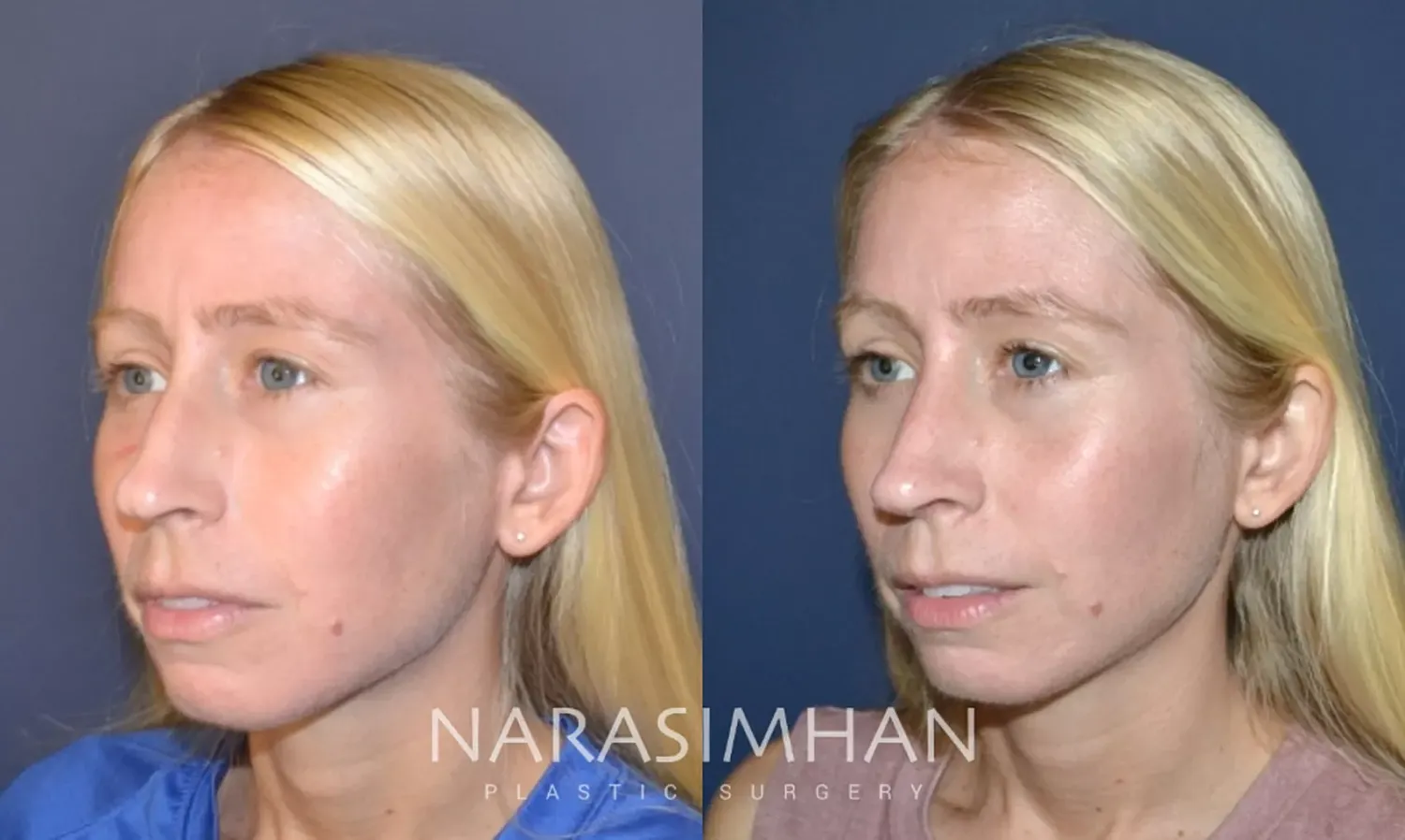 Facial Sculpting Before & After