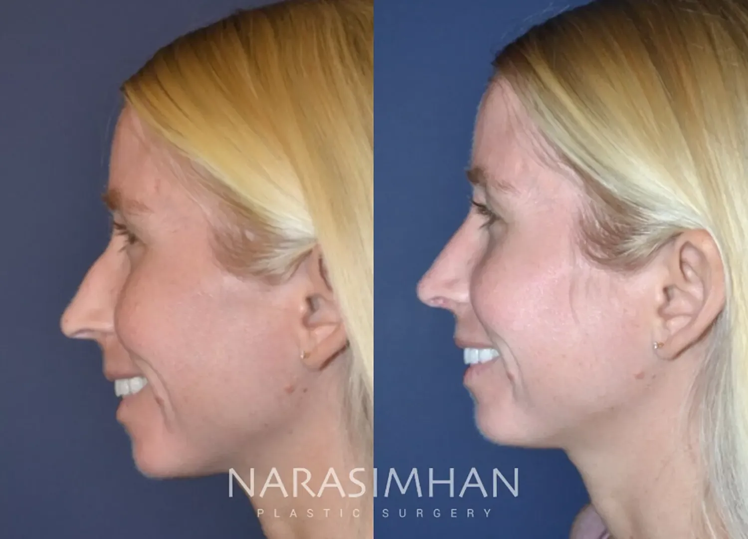 Facial Sculpting Before & After