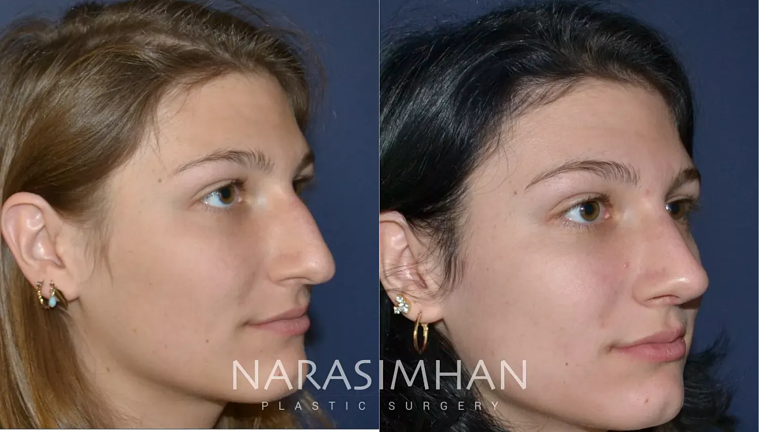 Facial Sculpting Before & After