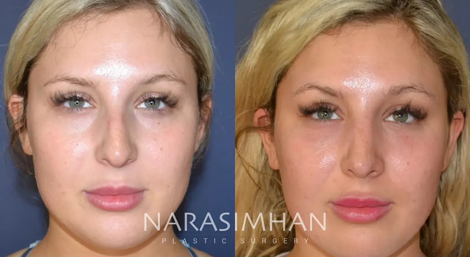 Facial Sculpting Before & After