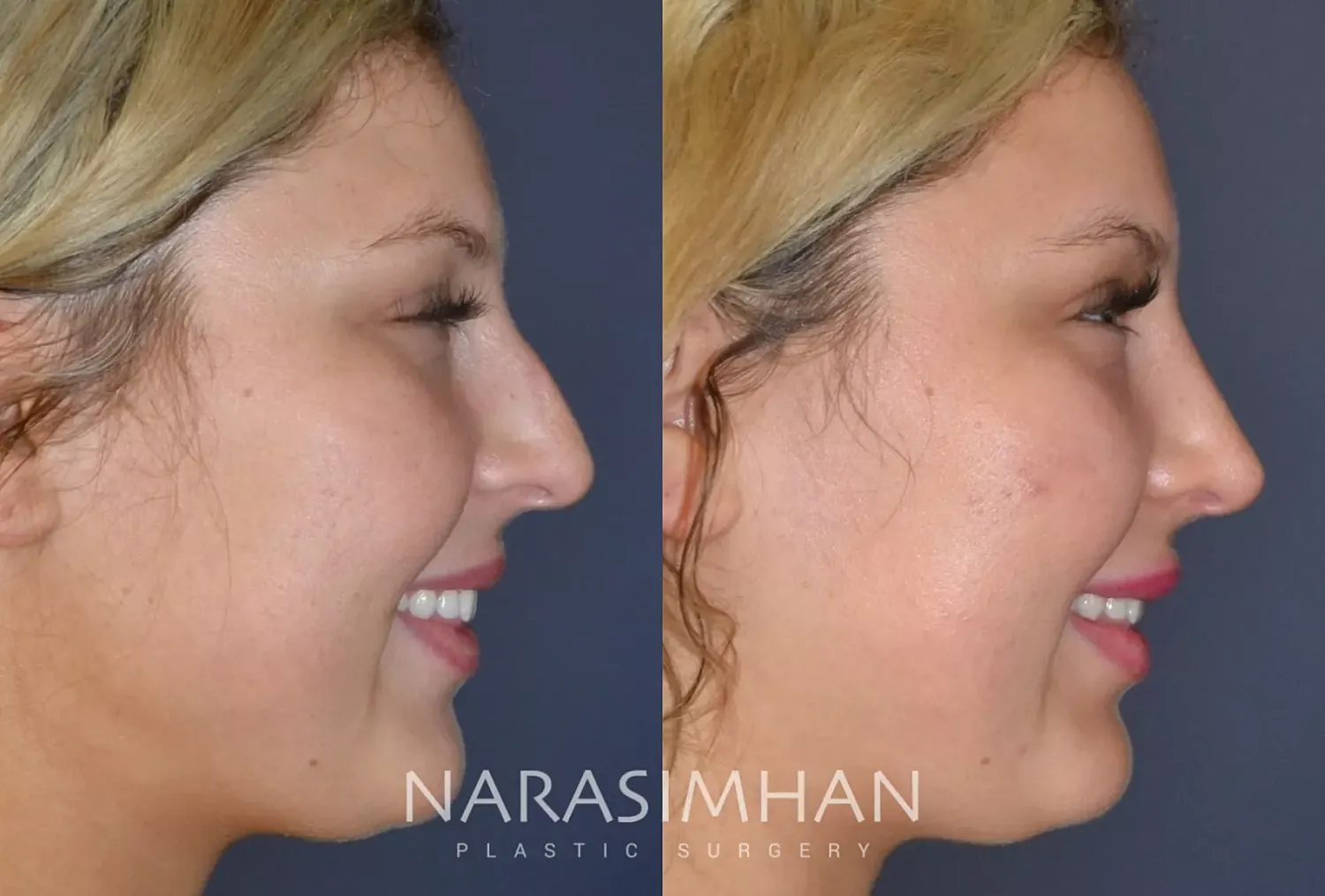 Facial Sculpting Before & After