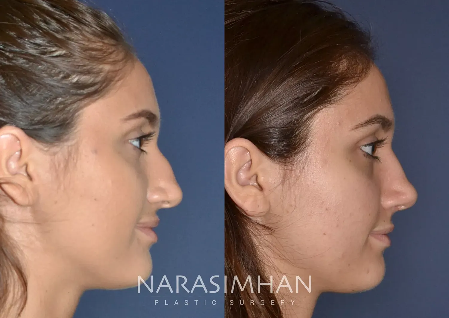 Facial Sculpting Before & After