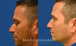 Facial Sculpting Before & After