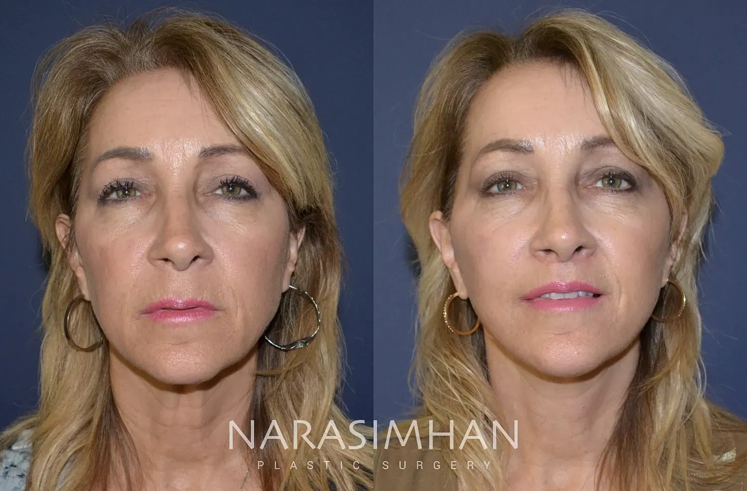Facial Sculpting Before & After