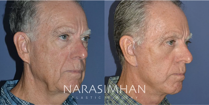 Facial Sculpting Before & After