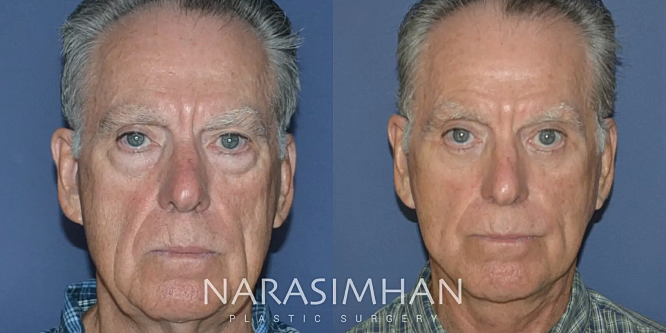 Facial Sculpting Before & After