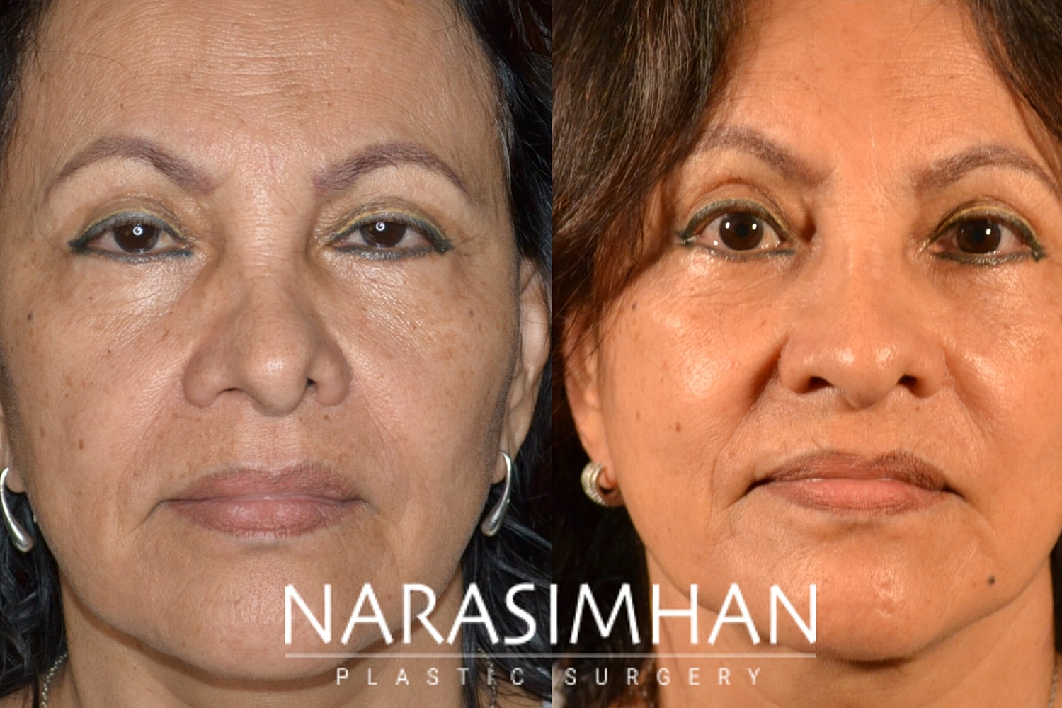 Facial Sculpting Before & After