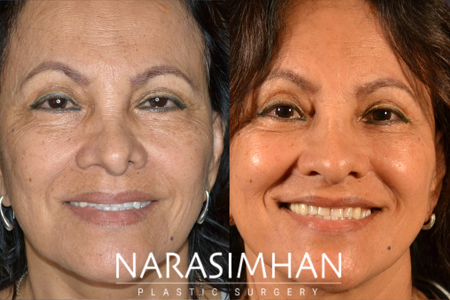 Facial Sculpting Before & After
