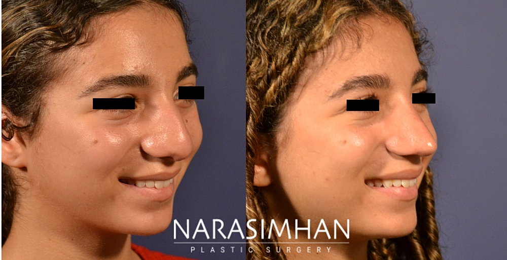 Facial Sculpting Before & After