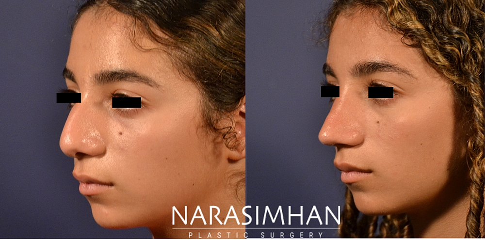 Facial Sculpting Before & After