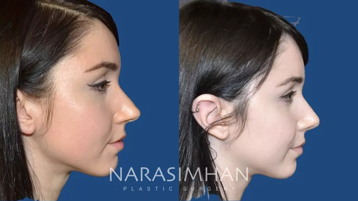 Facial Sculpting Before & After