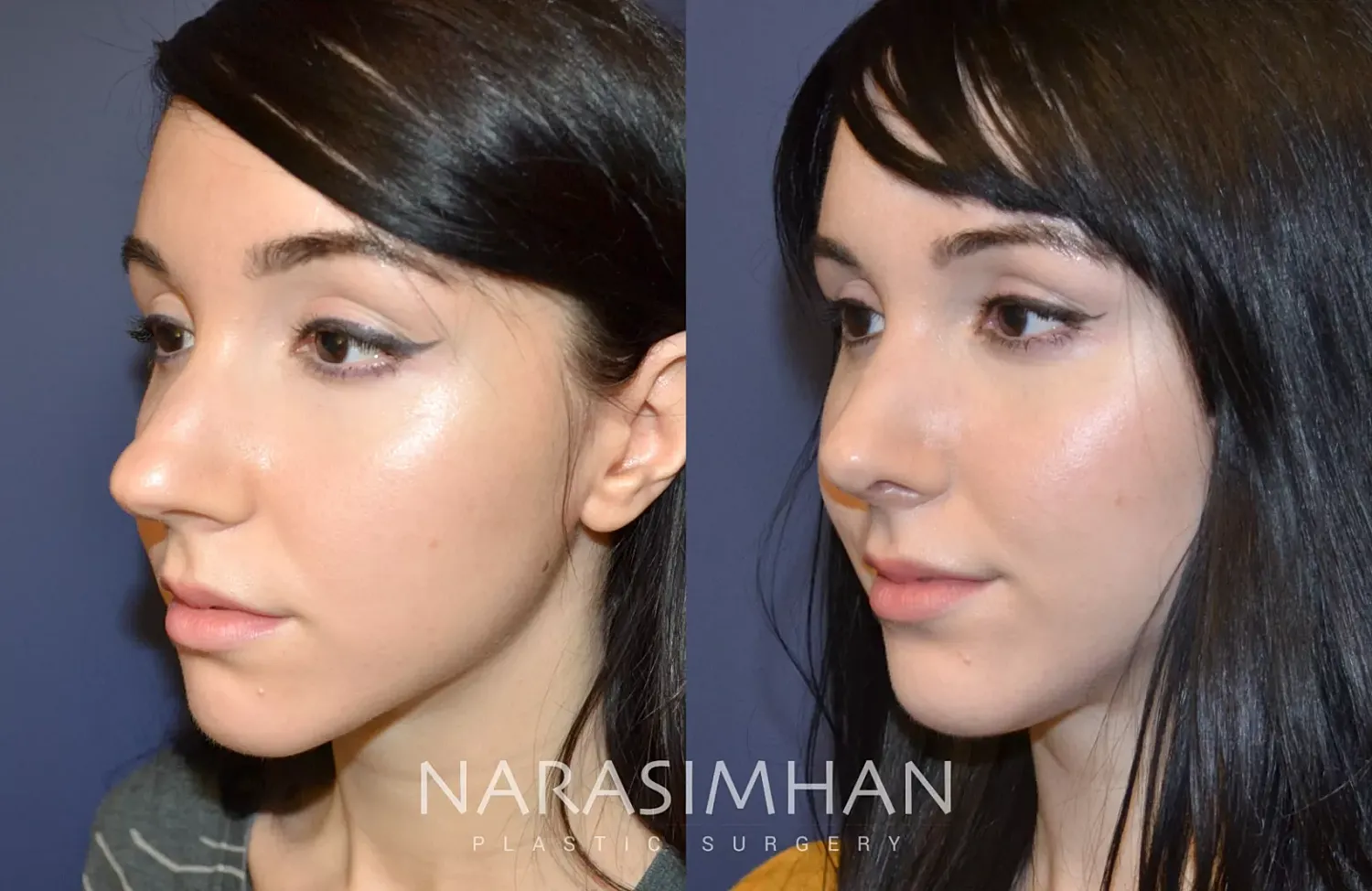 Facial Sculpting Before & After