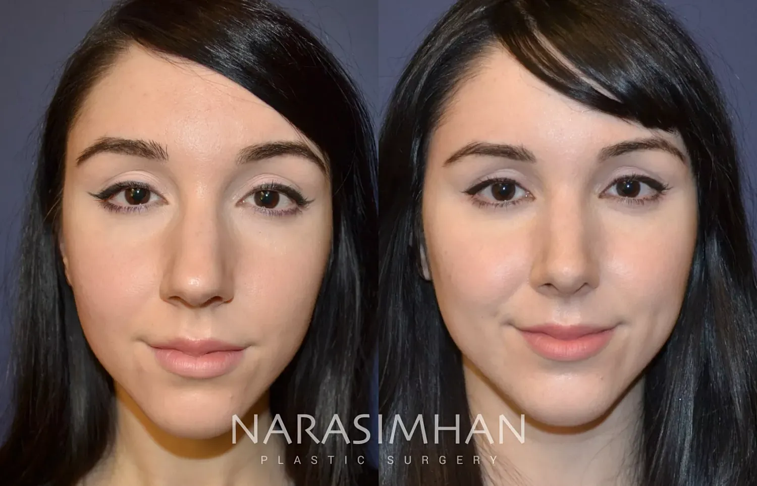 Facial Sculpting Before & After