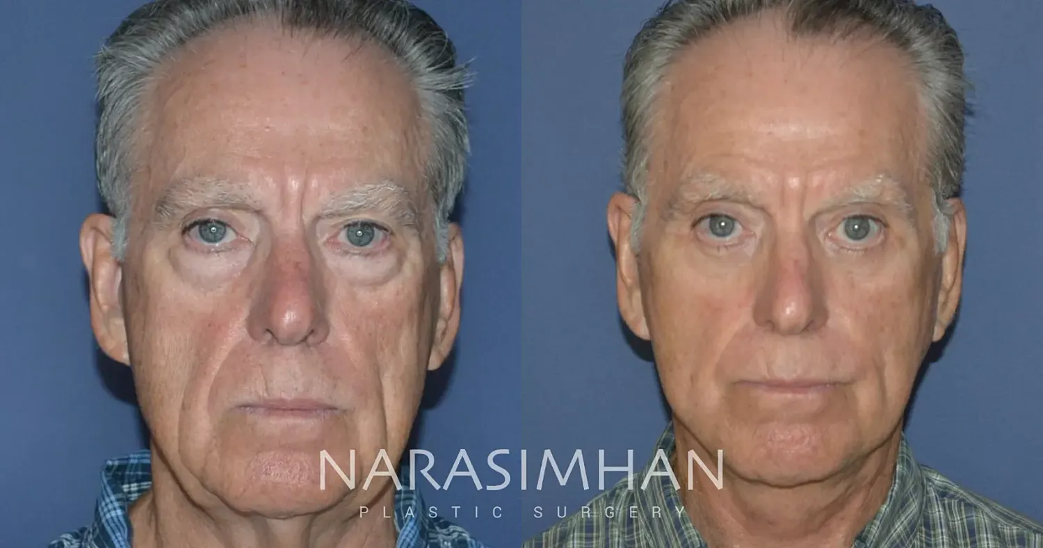 Facial Sculpting Before & After