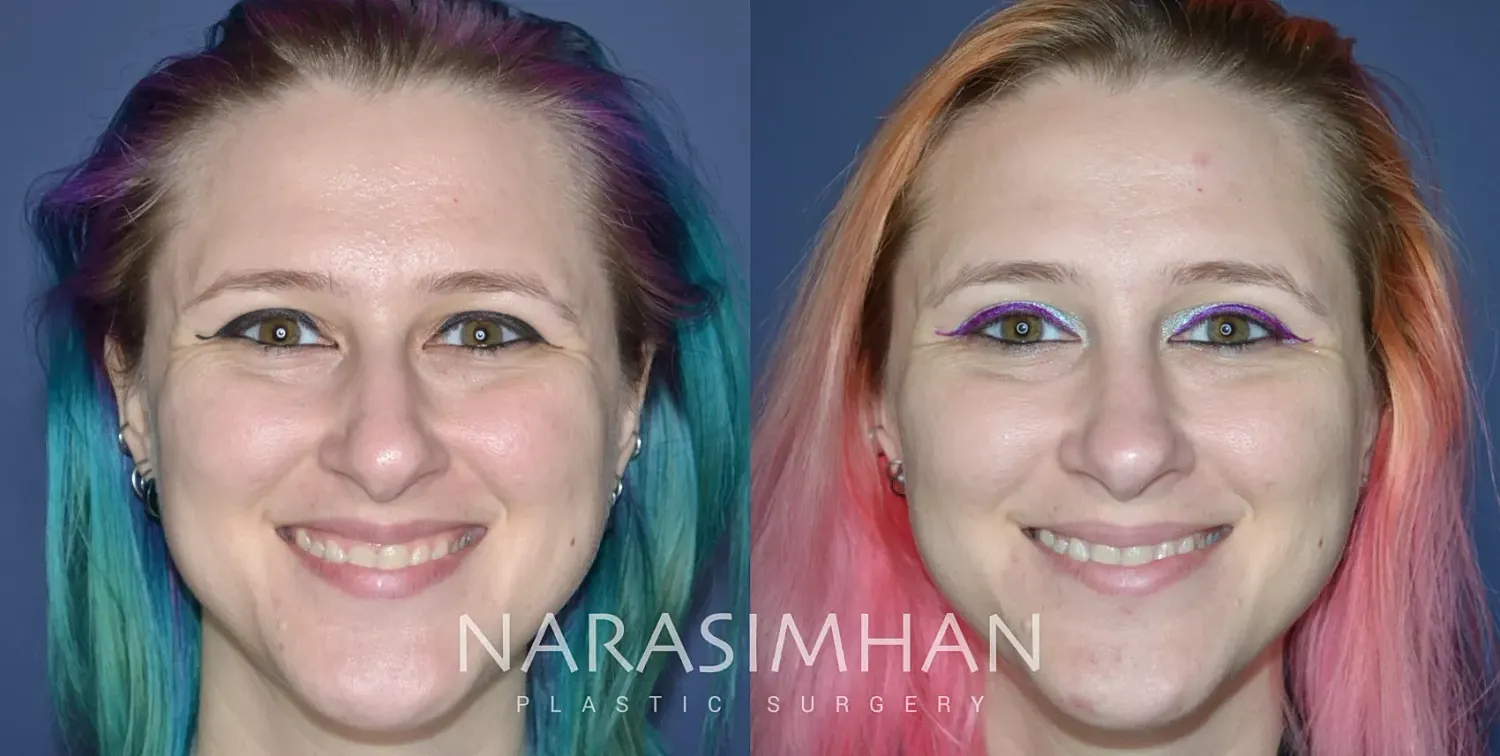 Facial Sculpting Before & After