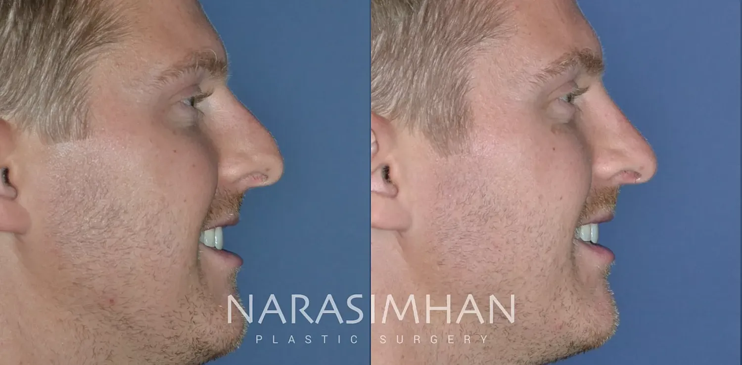 Facial Sculpting Before & After
