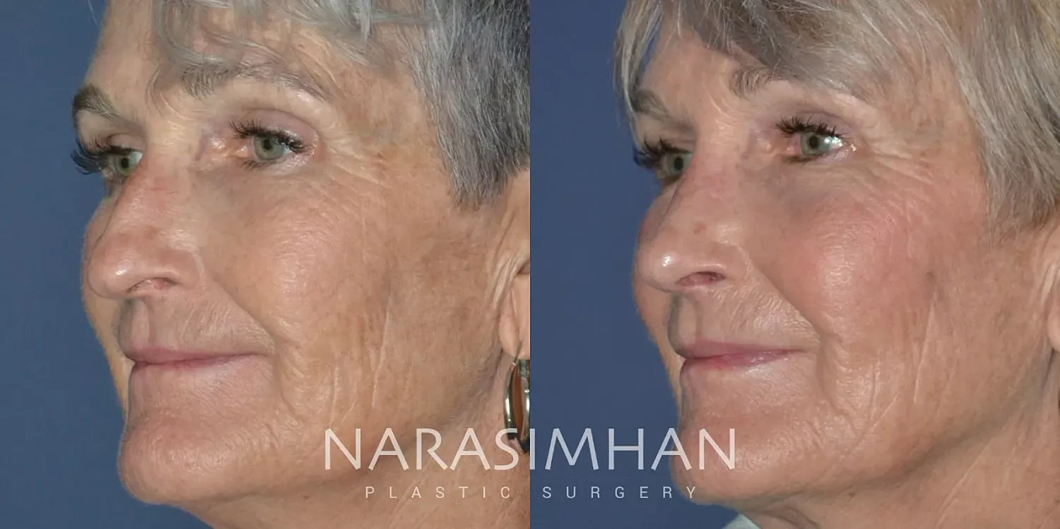 Facial Sculpting Before & After