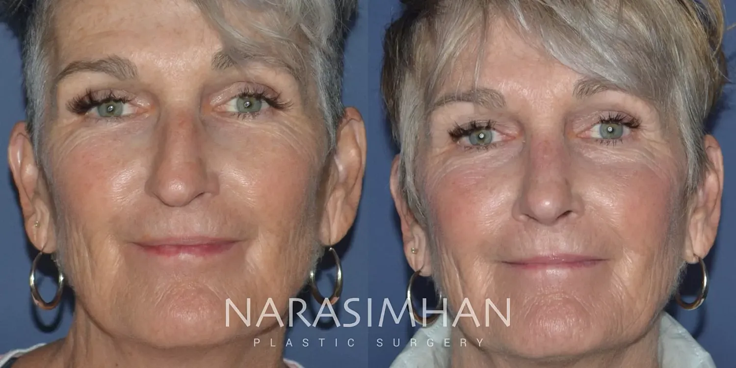 Facial Sculpting Before & After