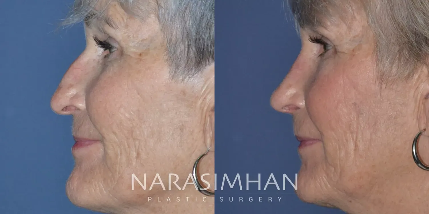 Facial Sculpting Before & After