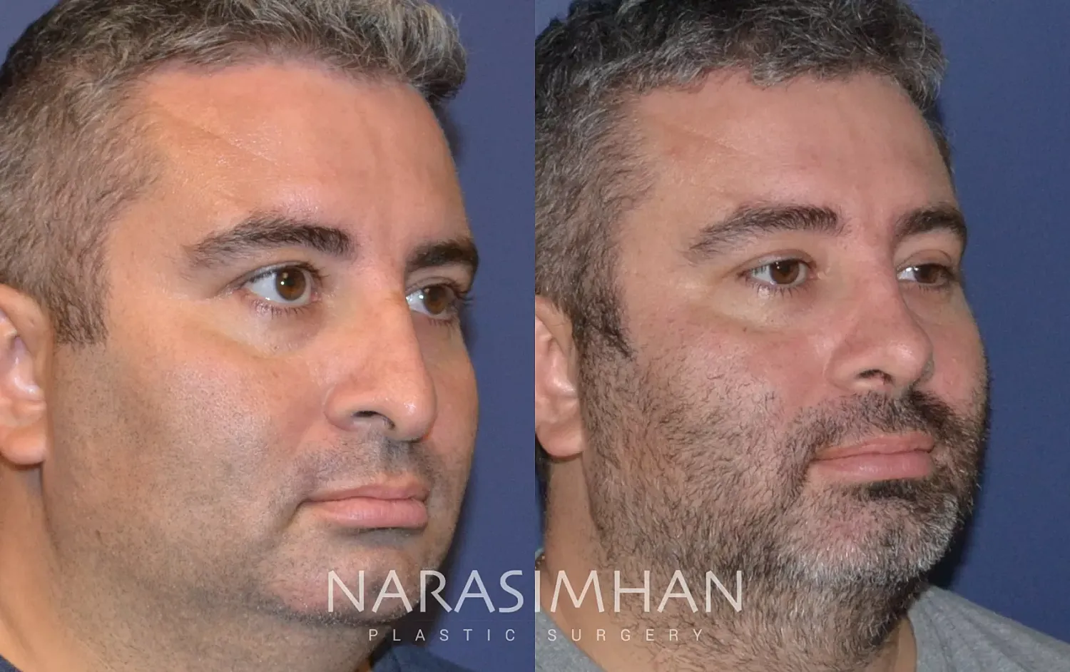 Facial Sculpting Before & After