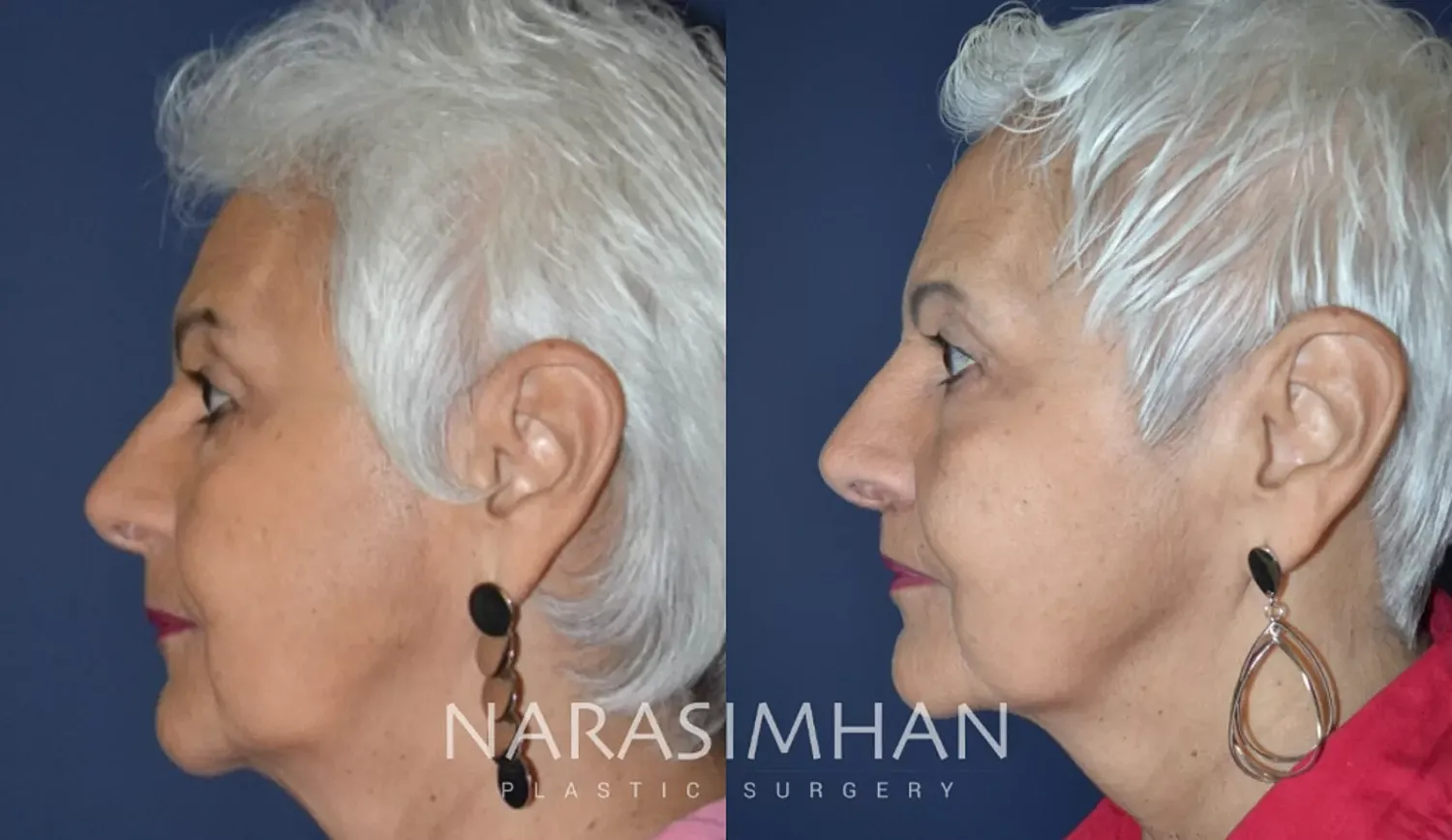 Facial Sculpting Before & After