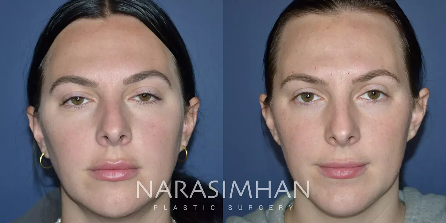 Facial Sculpting Before & After