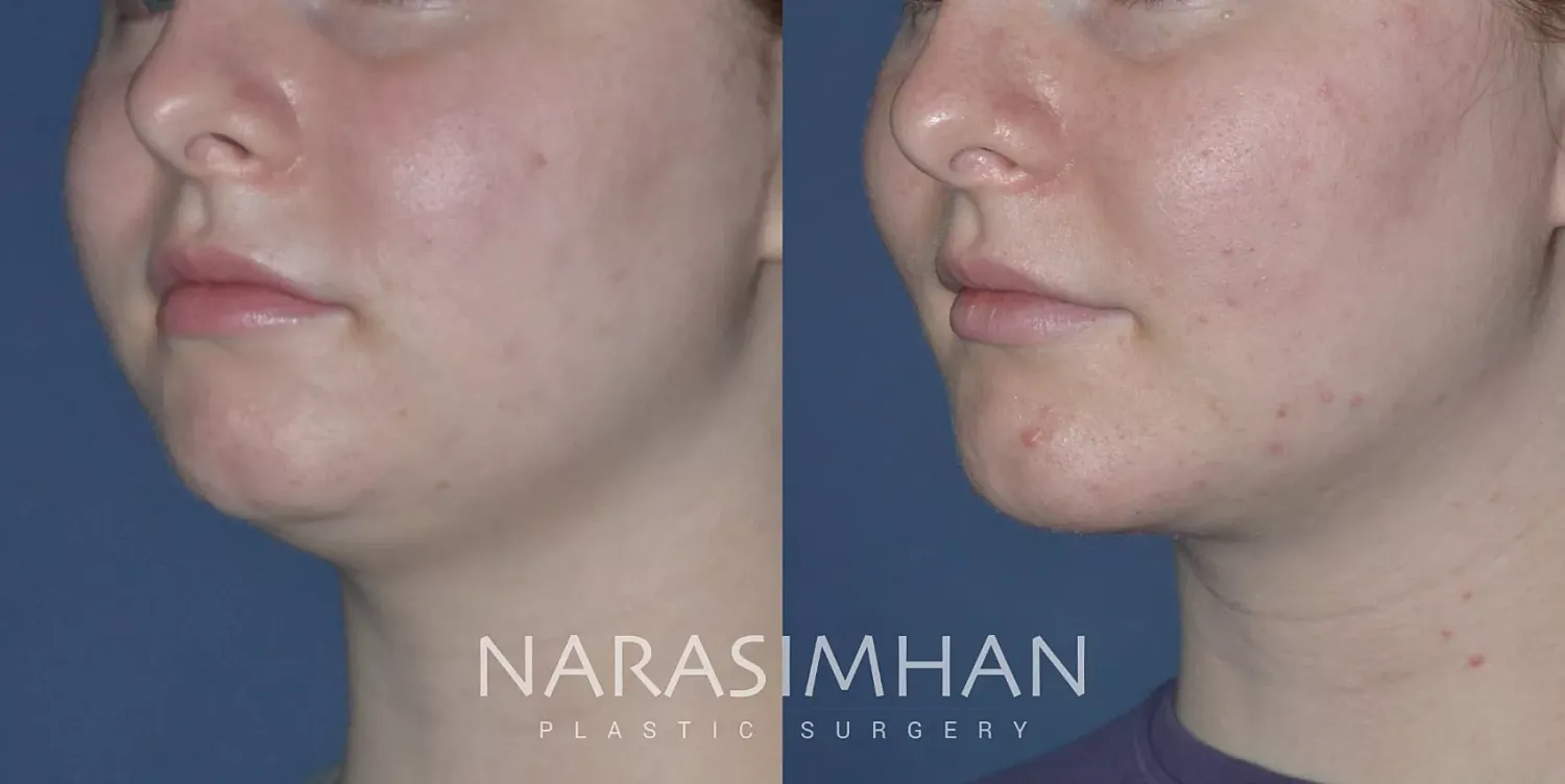 Facial Sculpting Before & After