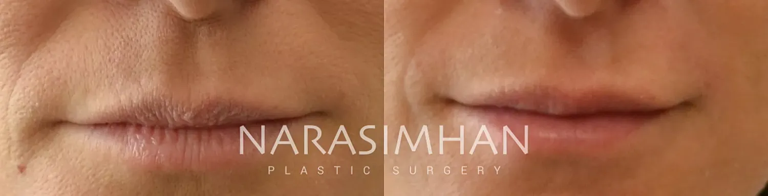 Facial Sculpting Before & After