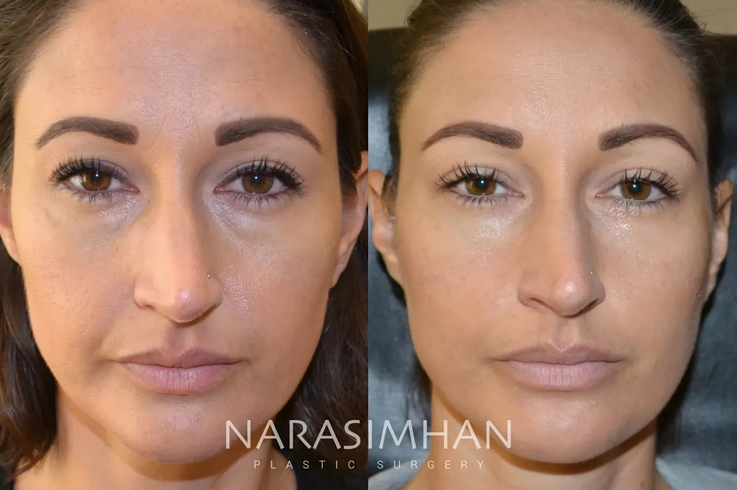 Facial Sculpting Before & After