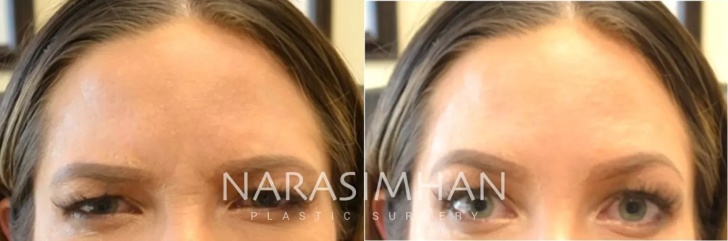 Facial Sculpting Before & After