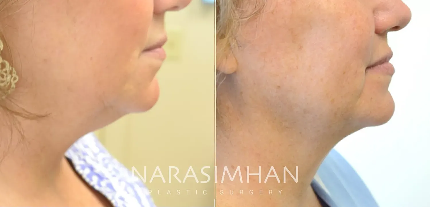 Facial Sculpting Before & After