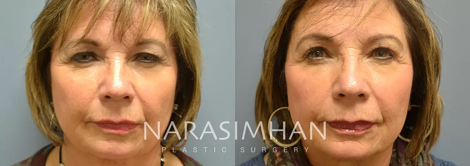 Facial Sculpting Before & After