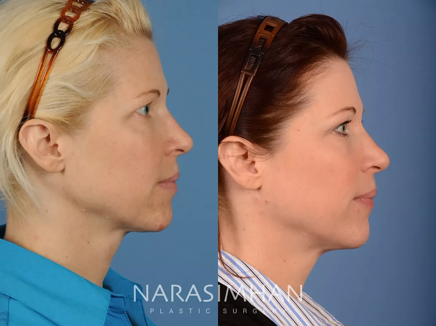 Facial Sculpting Before & After